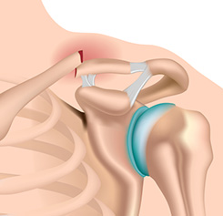 artroza deformantă a articulațiilor șoldului