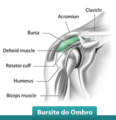 Bursite do Ombro